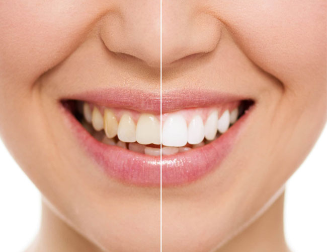 Diş Beyazlatma Zararlı mıdır?