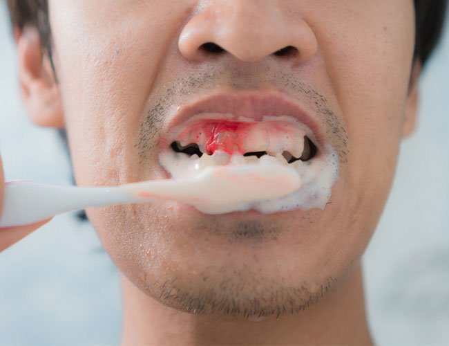 Diş eti kanamasının nedenleri