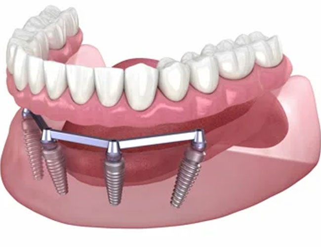 Hassas bağlantılı (Çıtçıtlı protez) nedir?